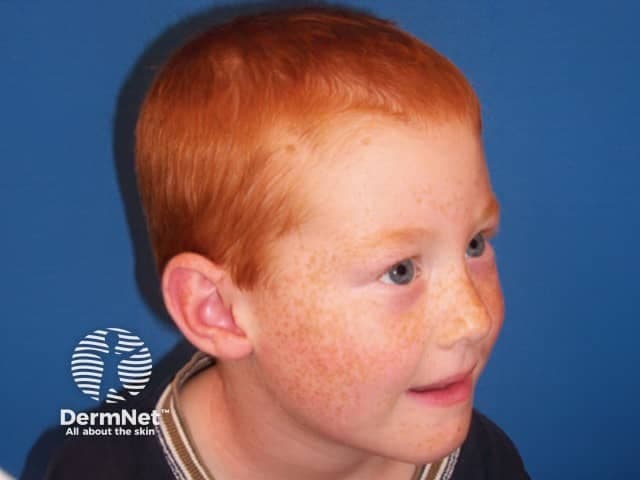 Freckles ephelides on face