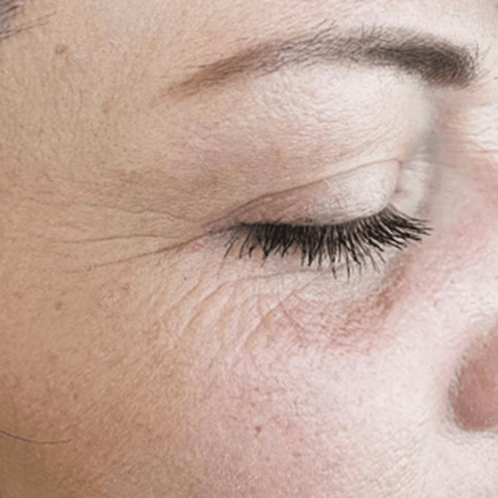 Rejuran before and after results 1 - Before