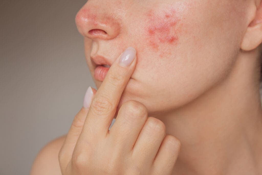 Active acne and breakout treatment at 99 Medispa Sydney