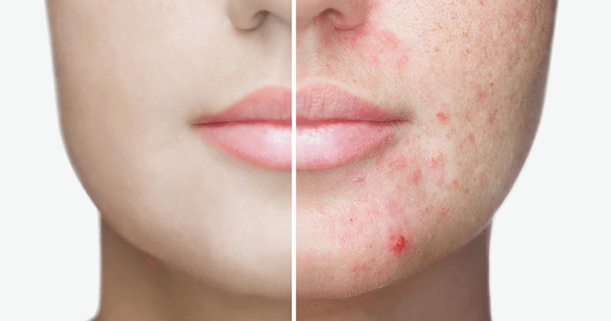 Twinlight Acne Nd:YAG laser treatment for active acne at 99 Medispa Sydney