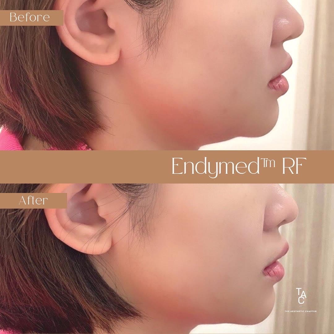 EndyMed RF before and after — double chin reduction