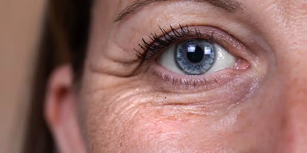 Under-eye lines and eye concerns treated at 99 Medispa Sydney