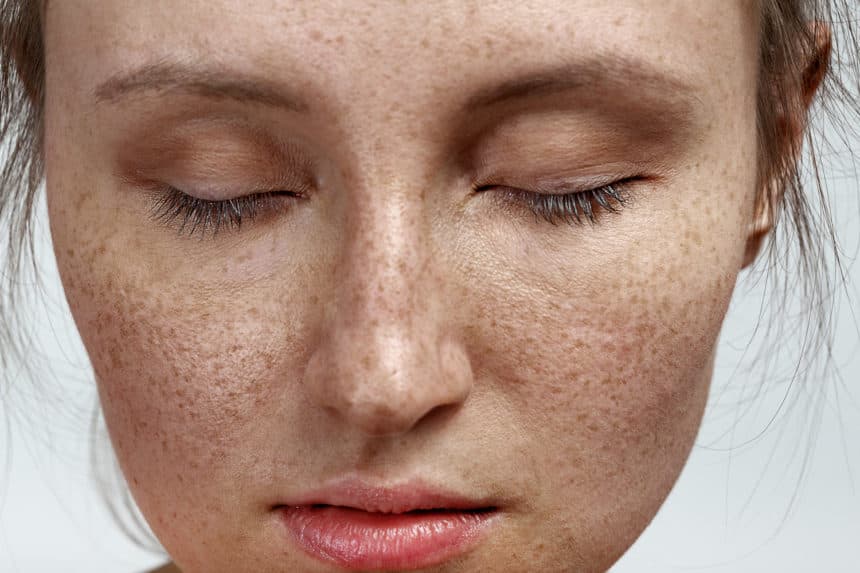 Pigmentation and brightening treatment at 99 Medispa Sydney
