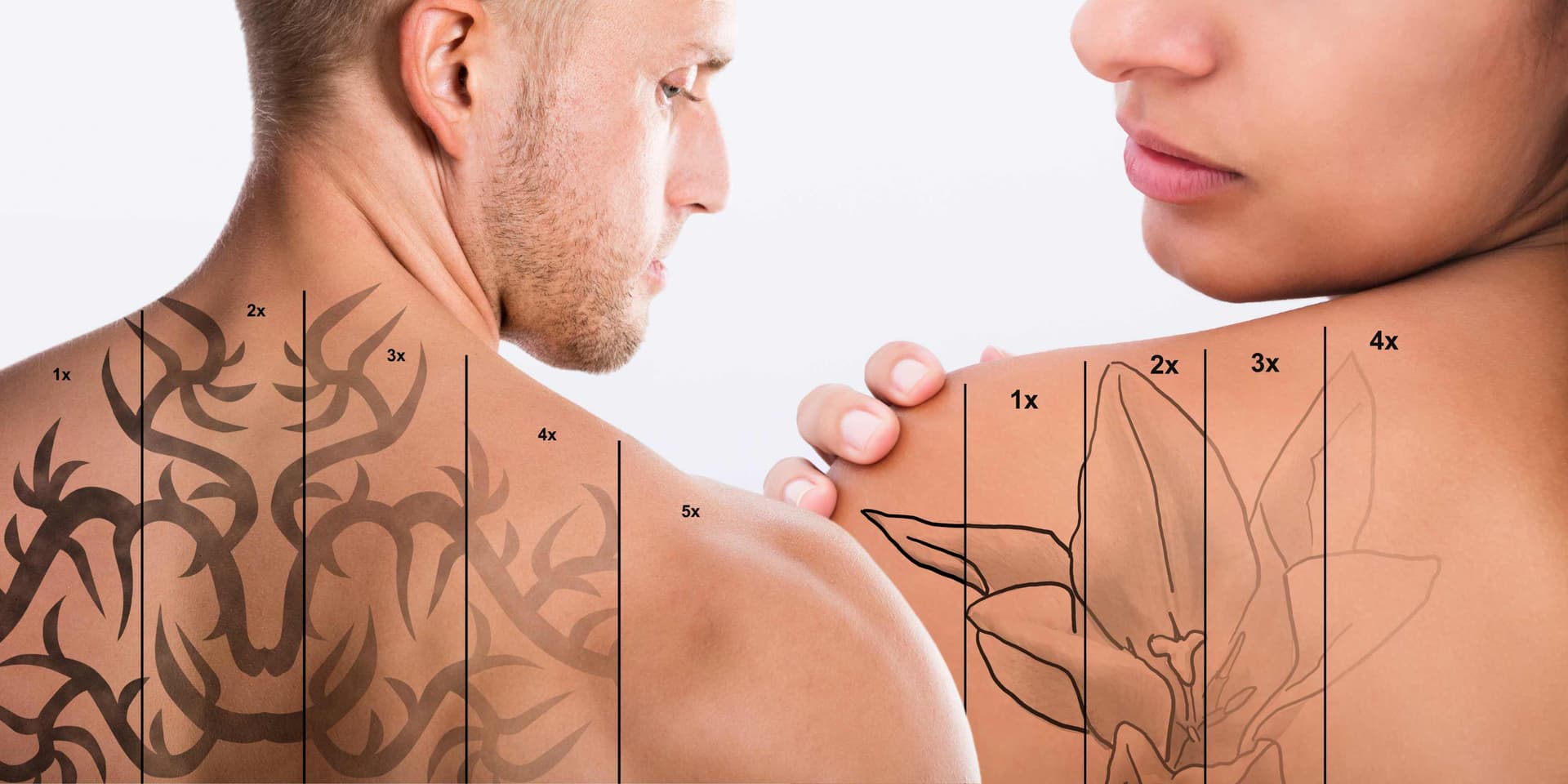 Laser tattoo removal treatment at 99 Medispa