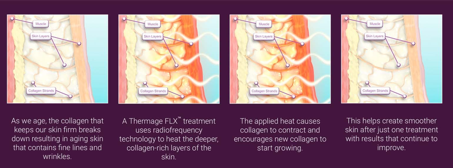 Thermage FLX how it works