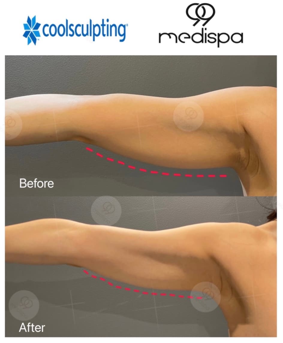 Arm contouring treatment result
