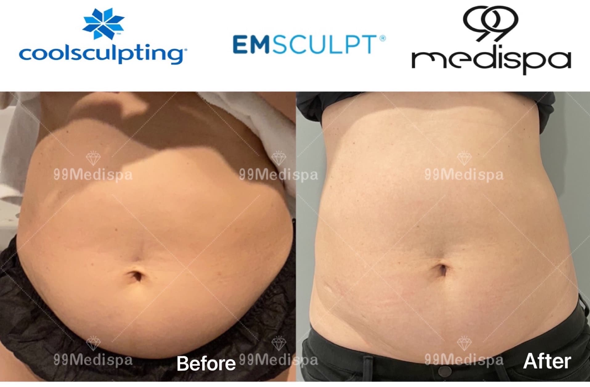 Combined body contouring result