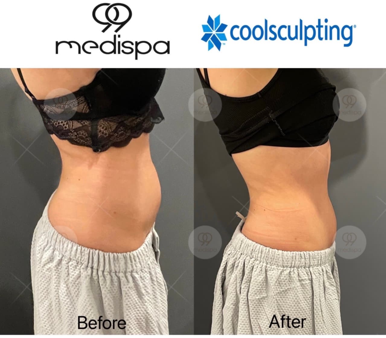 CoolSculpting body treatment result