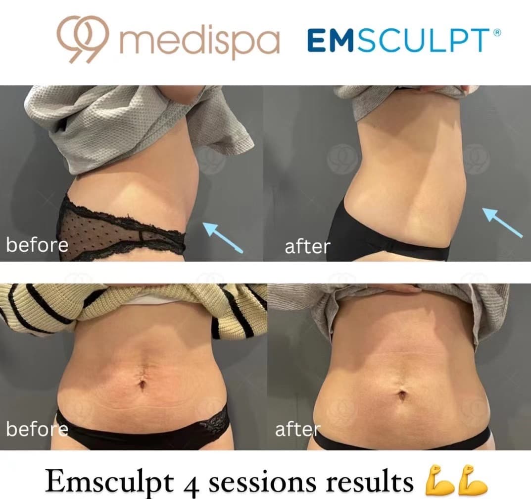 EMSCULPT body contouring result