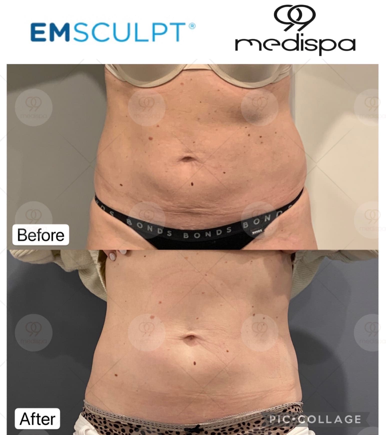 Body sculpting transformation at 99 Medispa