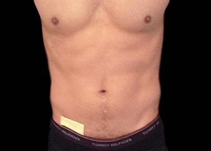 EMSCULPT before and after results - male abdomen transformation - After