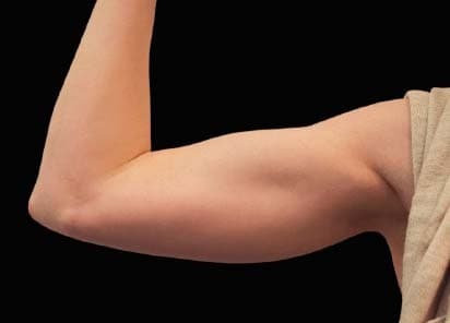 EMSCULPT before and after results - arms transformation - After