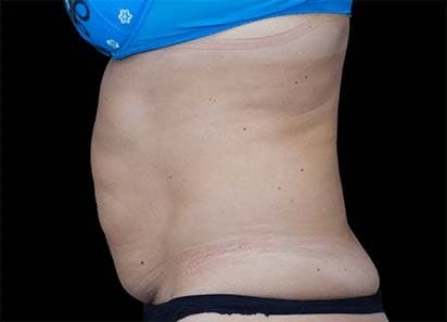 EMSCULPT before and after results - female abdomen transformation - Before