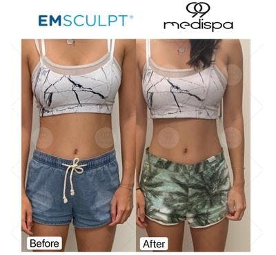 Emsculpt abs before and after